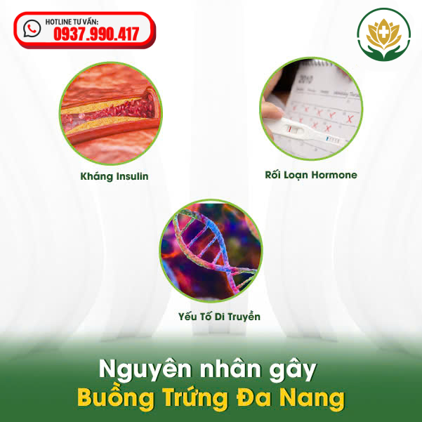 Nguyên nhân gây buồng trứng đa nang