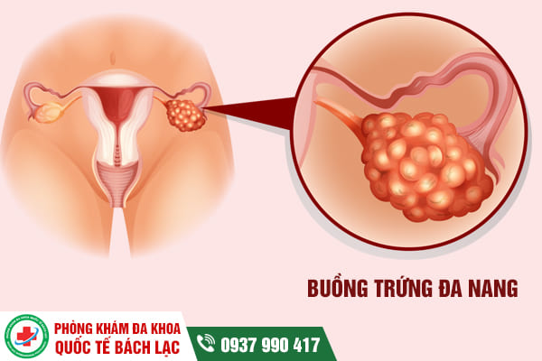 Những dấu hiệu của đa nang buồng trứng nữ giới cần chú ý