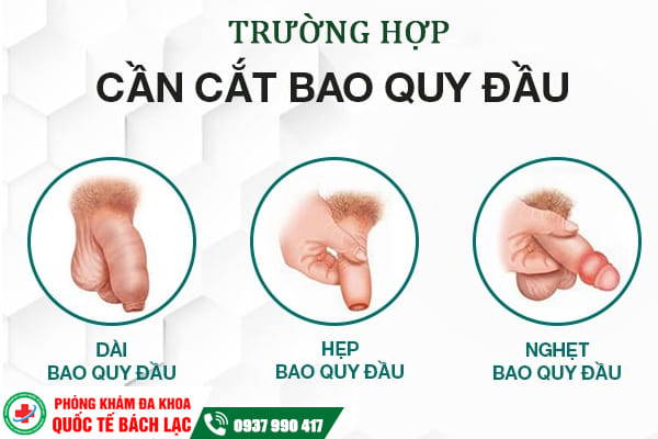 Cắt bao quy đầu không đau ở Buôn Ma Thuột - An toàn, kín đáo