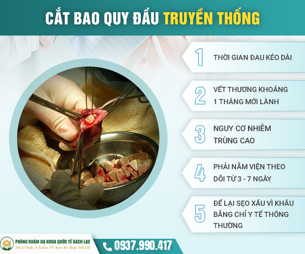 Cắt bao quy đầu truyền thống (dùng dao kéo)