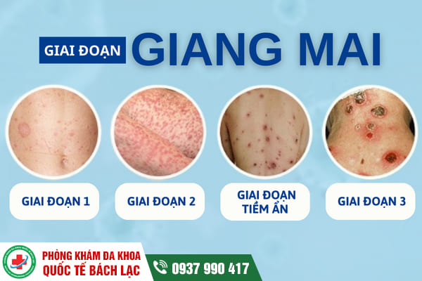 Phòng khám chữa bệnh giang mai ở Buôn Ma Thuột hiệu quả, uy tín