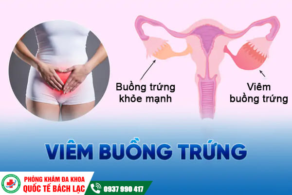 Những bệnh lý buồng trứng thường gặp chị em cần cảnh giác