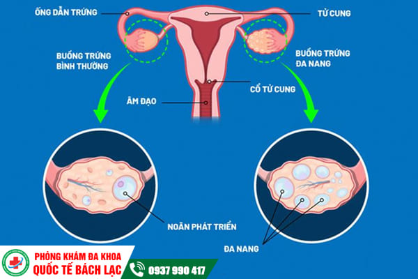 Những bệnh lý buồng trứng thường gặp chị em cần cảnh giác