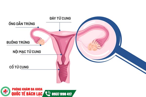 Những bệnh lý buồng trứng thường gặp chị em cần cảnh giác