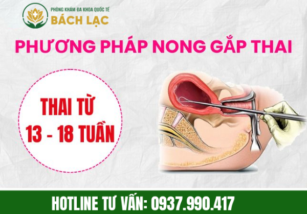 Đình chỉ thai bằng phương pháp nong gắp thai