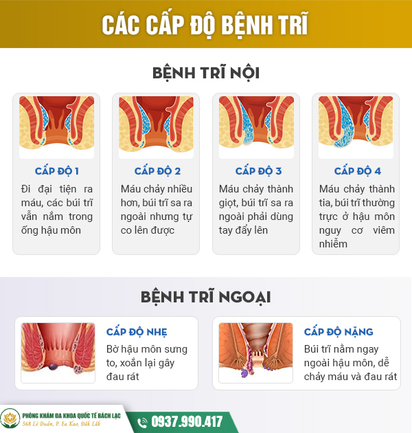 Các cấp độ của bệnh trĩ