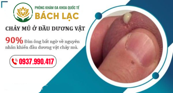 Dấu hiệu cảnh báo dương vật chảy mủ - nam giới cần lưu ý