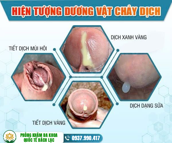 Khi nào nam giới cần đi khám dương vật chảy mủ Đắk Lắk?