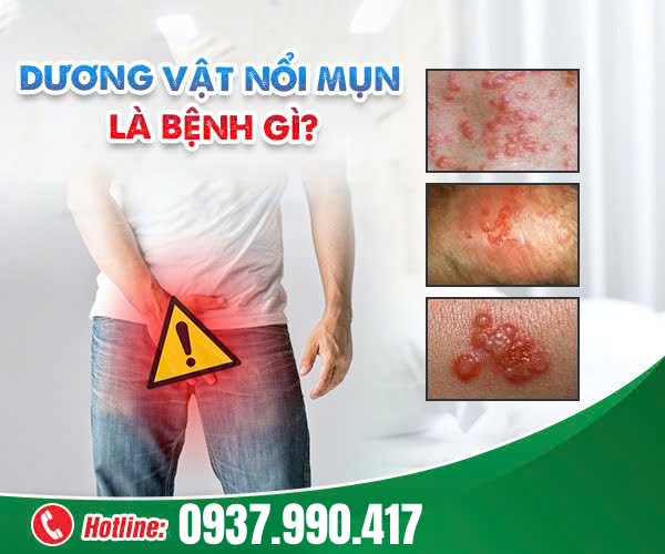 Dương Vật Nổi Mụn Là Dấu Hiệu Của Bệnh Gì?