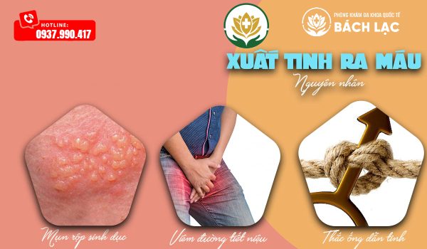 Xuất tinh ra máu là gì? Nguyên nhân gây xuất tinh ra máu là gì?
