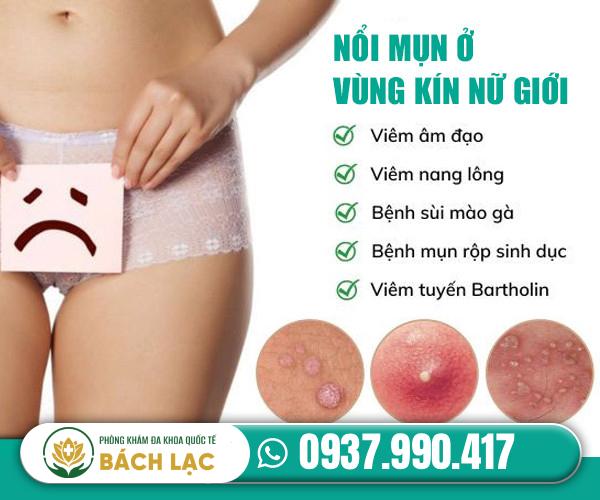 Vùng kín nổi mụn là dấu hiệu cảnh báo bệnh gì?