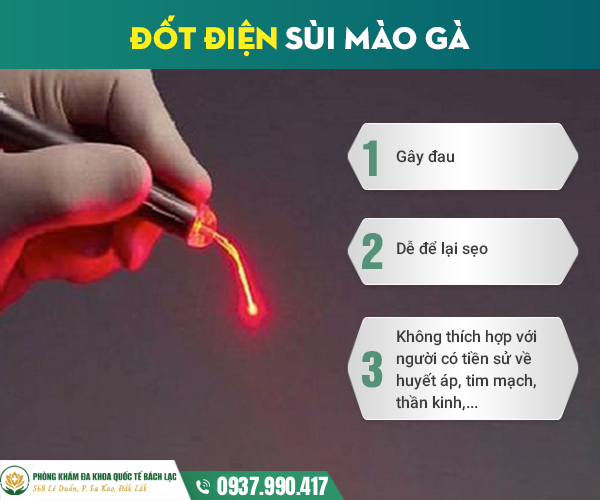 Chữa sùi mào gà bằng phương pháp đốt điện