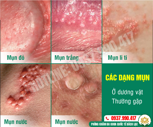 Các dạng mụn thường gặp ở dương vật